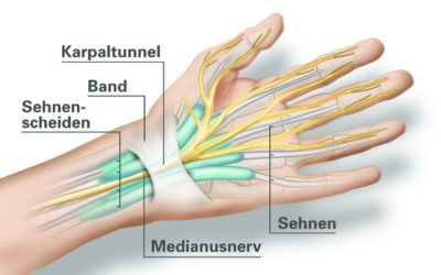 Carpaltunnelsyndrom (CTS)