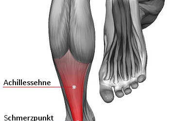 Achillessehnenprobleme